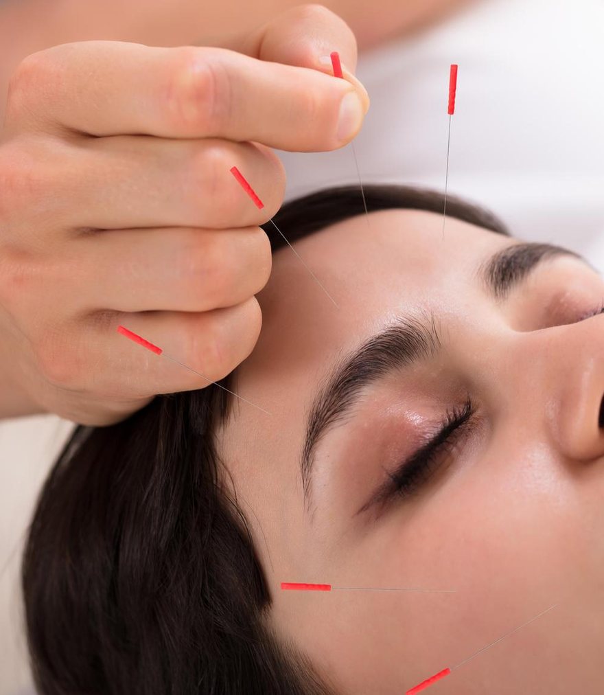 A fine acupuncture needle being placed gently at the forehead during a treatment