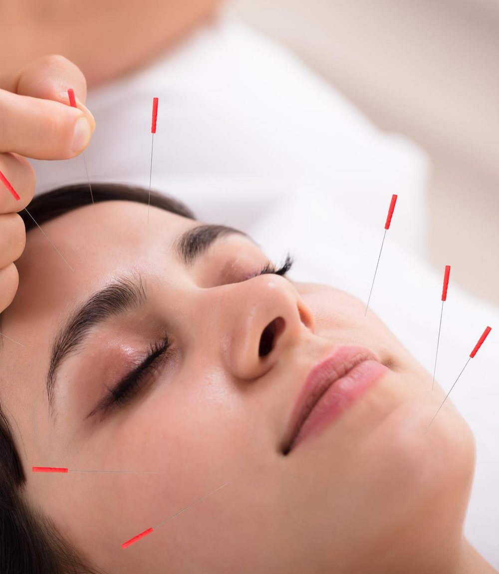 A woman resting calmly during a facial acupuncture treatment, with fine needles in place